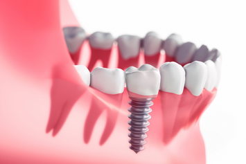 dental implants at baghel's dentalworld