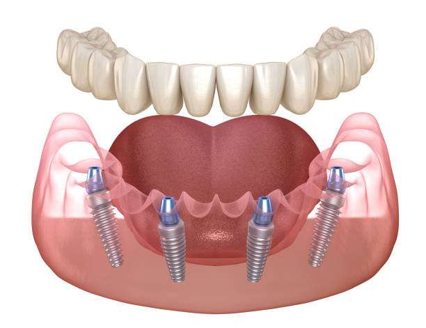 all on 4 dental implant providers Mumbai India Goregaon east