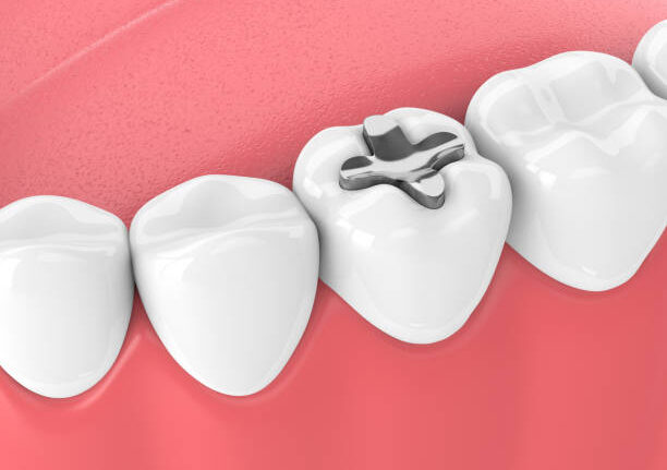 dental fillings cavity filling