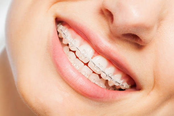 ceramic braces or composite braces or tooth colored braces