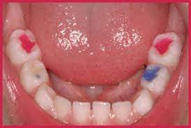 colored tooth filling compomer 