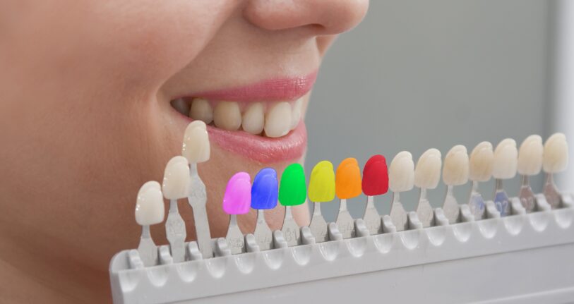 colored dental fillings goregaon east