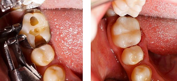 tooth colored filling