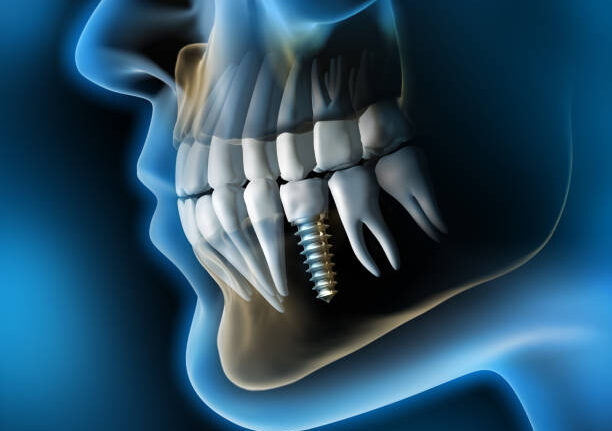dental implant treatment mumbai