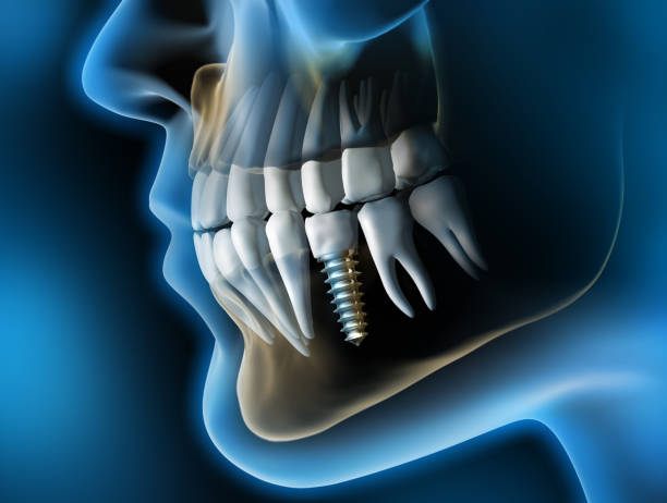 dental implant treatment mumbai