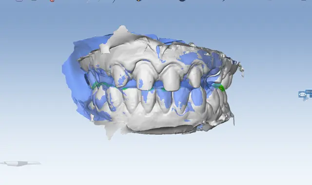 digital dental scan of teeth used in goregaon east