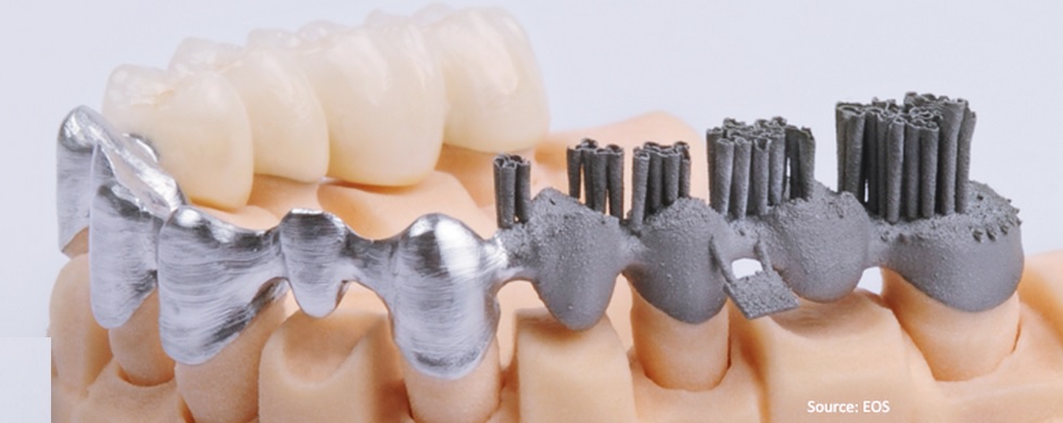3d printed dmls crown and bridge on dental cast