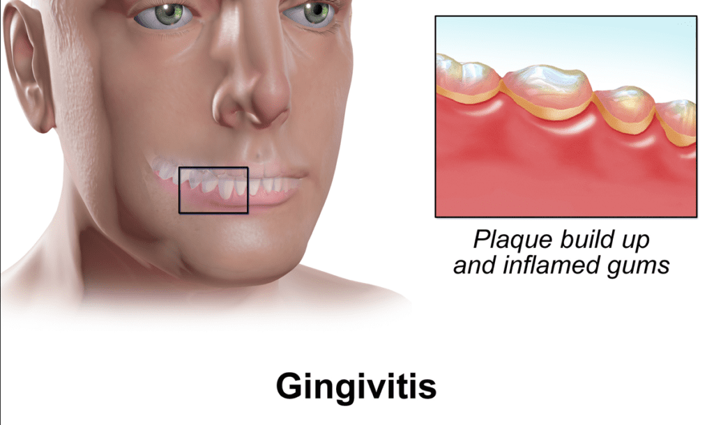 plaque leading to gingivitis