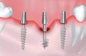 basal and immediate implants in mumbai