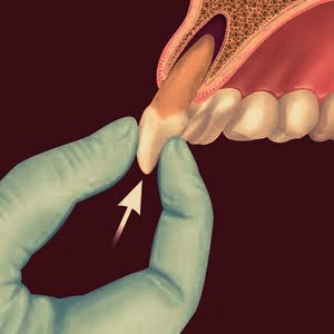 replantation of dislodged tooth in Mumbai