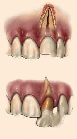 partial or intruded tooth due to accident treatment in mumbai goregaon east