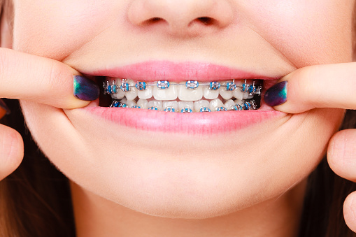 metal braces with elastic module mumbai