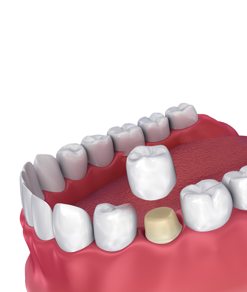 Dental cap after root canal mumbai