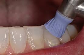 teeth polishing mumbai