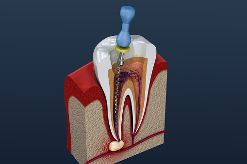why root canal treatment at baghels dental