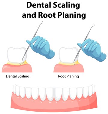 teeth scaling and root planing in goregaon east