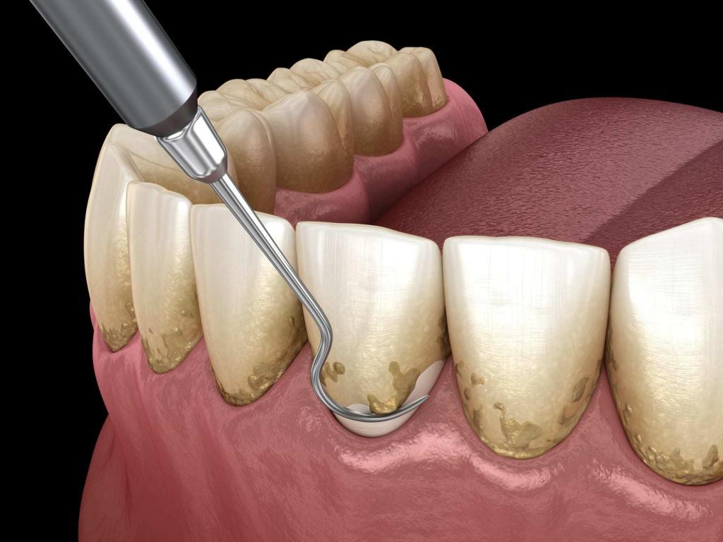 dental scaling and root planing 