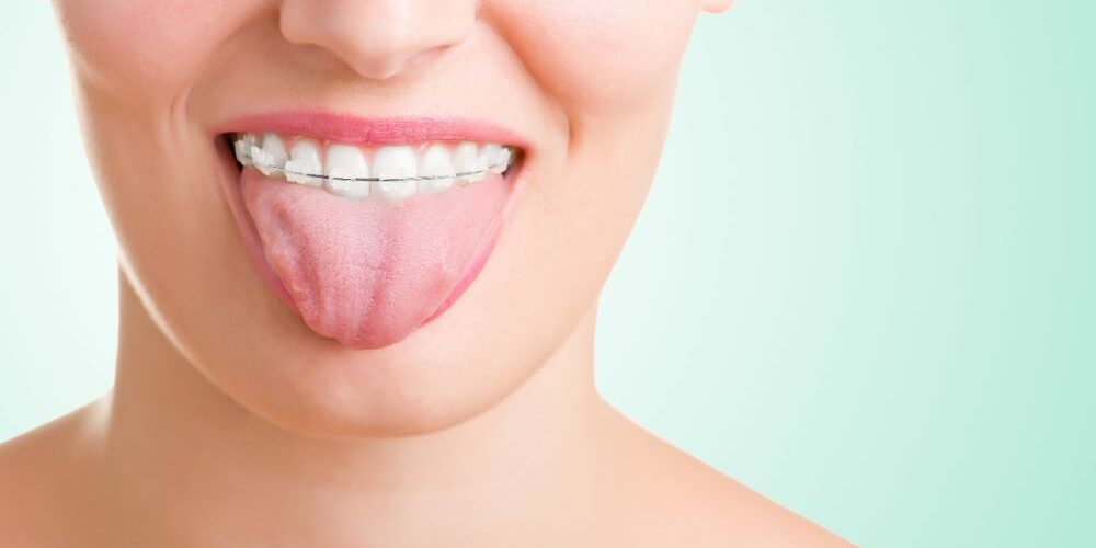 tongue thrust habit