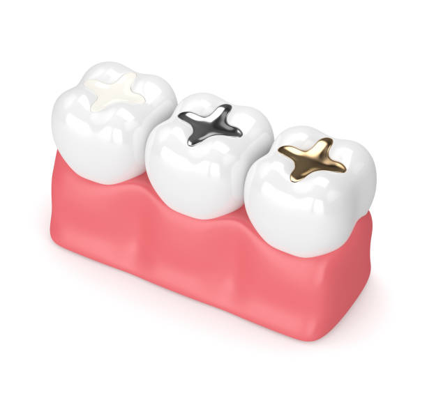tooth colored filling compared to silver and gold filling