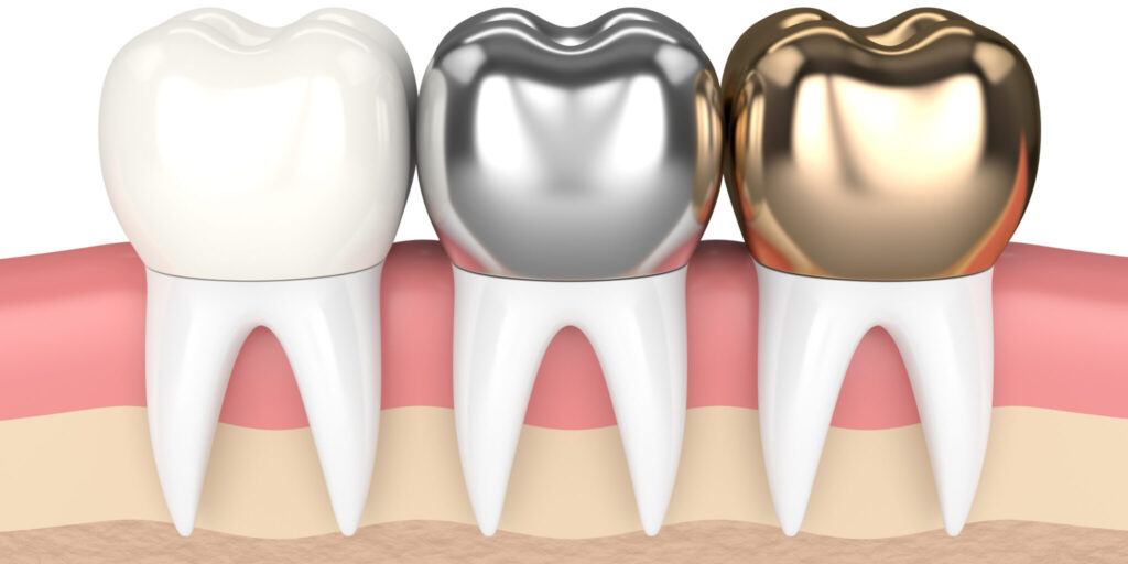 dental crowns cemented types 