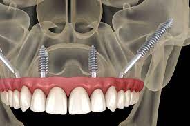 zygomatic implants in mumbai goregaon east