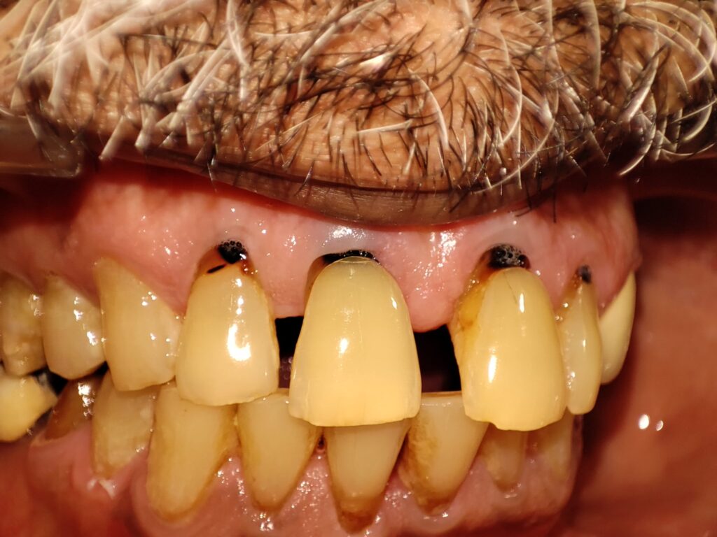 abfraction teeth