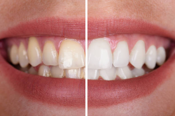 teeth before and after bleaching