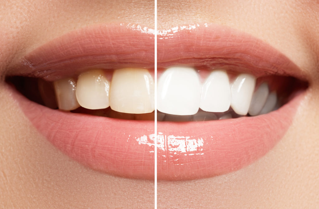 teeth whitening bleaching comparison before and after